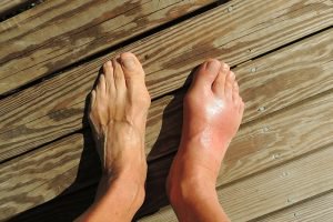 gout-flare-up